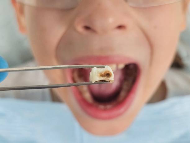 Best Emergency Tooth Extraction in Pearsall, TX